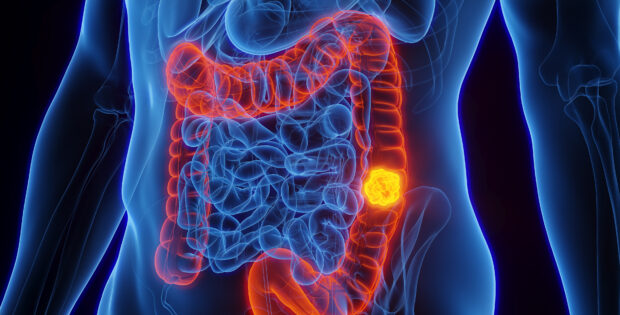She Wasn’t Due For Her Colonoscopy. A Blood Test Found Cancer Anyway